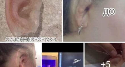 В Медицинском центре КГМА впервые изготовили искусственное ухо